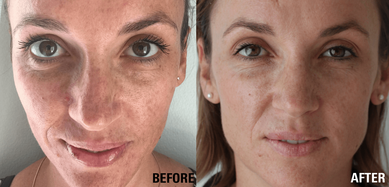 Before & After How to Reverse Sun Damage and Pigmentation Medico Beauty