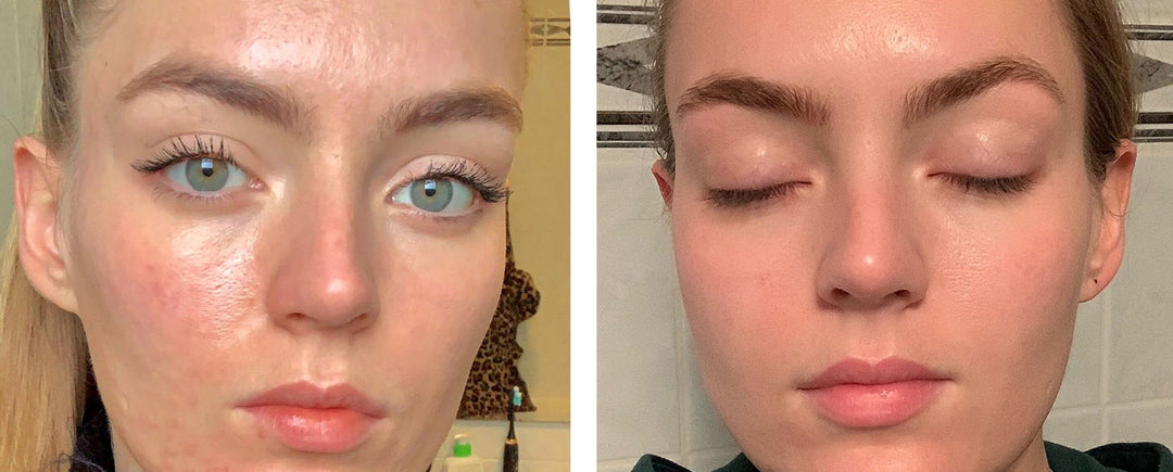 Adult Acne — Why it Keeps Repeating & How to Break the Cycle