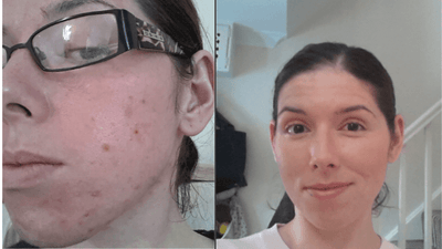 Before & After: Healing Acne and Other Skin Conditions with Peels