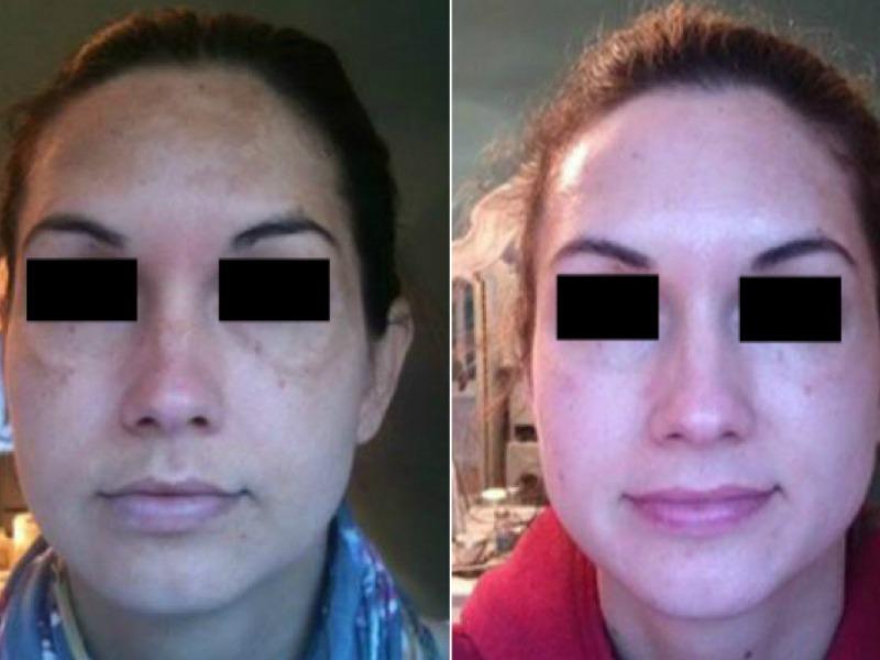 Before & After: How to Heal Sun Damage and Melasma