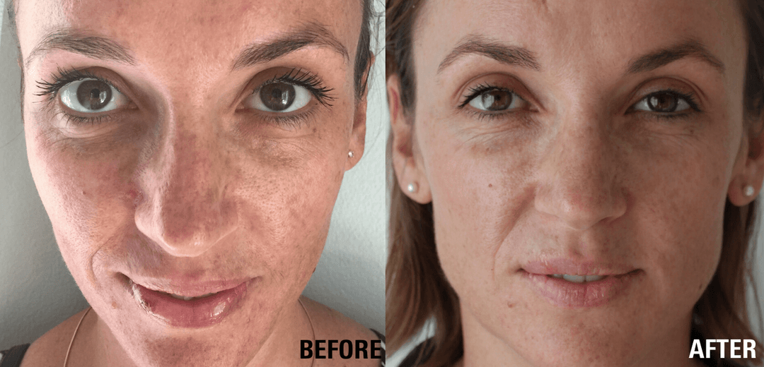 Before & After: How to Reverse Sun Damage and Pigmentation