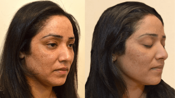 Before & After: How to Treat Dual Condition Skin - Melasma and Adult Acne