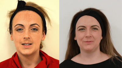 Before & After: How to Treat Melasma and Reveal a Beautiful Complexion