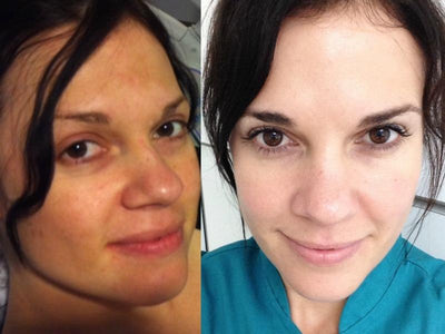 Before & After: Peels that Heal Hyperpigmentation and Even Out Skin Tone