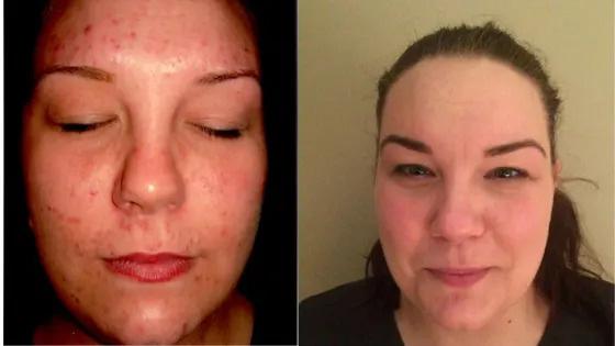 Before & After: The Gut-Complexion Connection: Healing Acne from the Inside Out