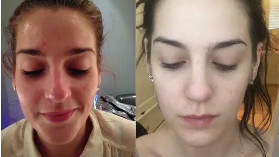 Before & After: Treat Adult Acne and Reveal a Clearer, Healthier Complexion