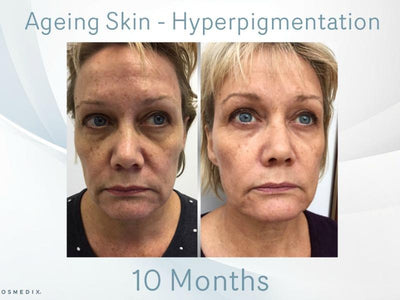 How to Address Hyper-pigmentation and Ageing to Revitalize Your Complexion