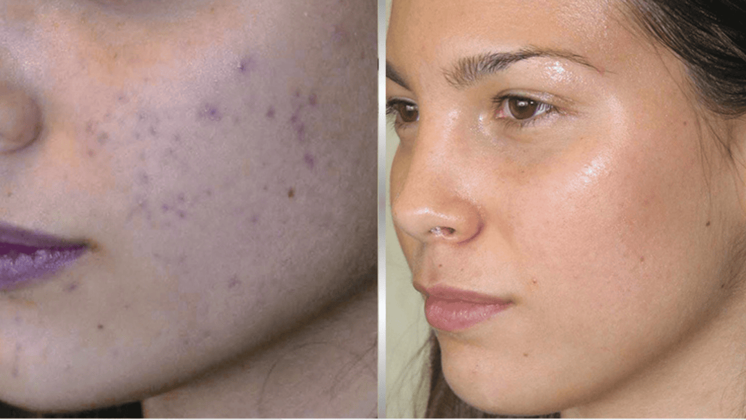 How to Get Clear Skin Without Over-Exfoliating