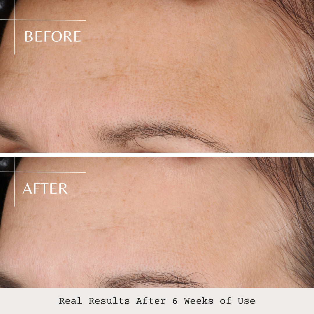 Purging vs Irritation: Why Your Skin Gets Worse Before It Gets Better — And When It Shouldn’t