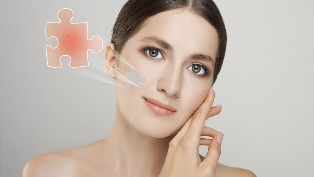 Rosacea Causes - Groundbreaking Discoveries explain common triggers of redness and spots