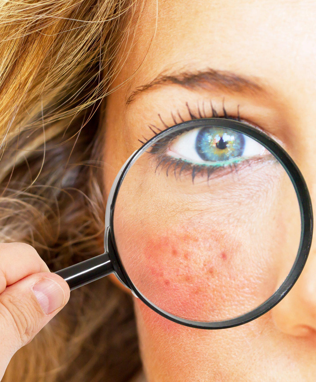 Rosacea Symptoms - Decode Your Rosacea Subtype