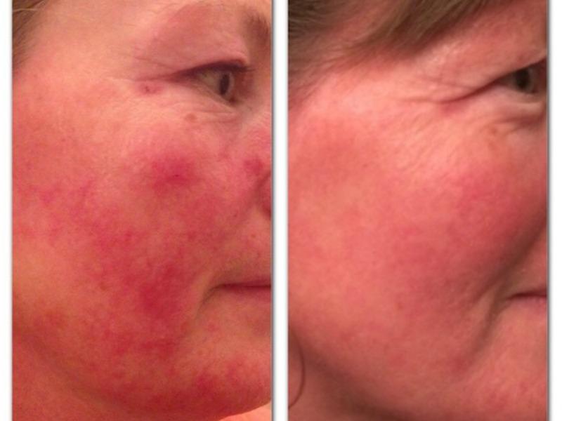 Rosacea Treatment – Christine