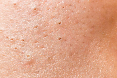 Understanding and Treating Enlarged Pores