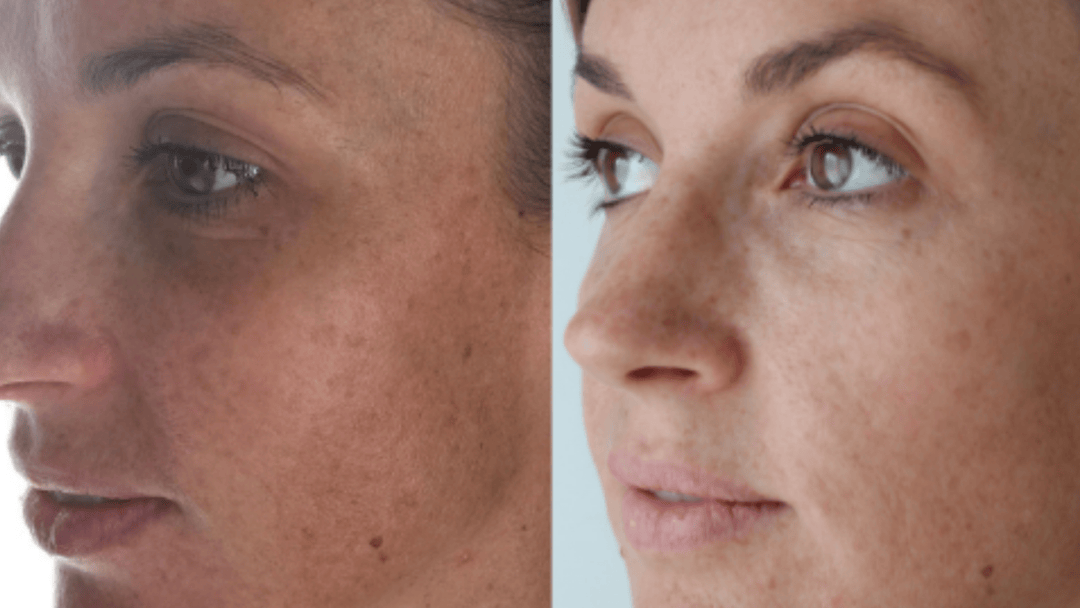 What Causes Pigmentation? And How to Treat It Properly