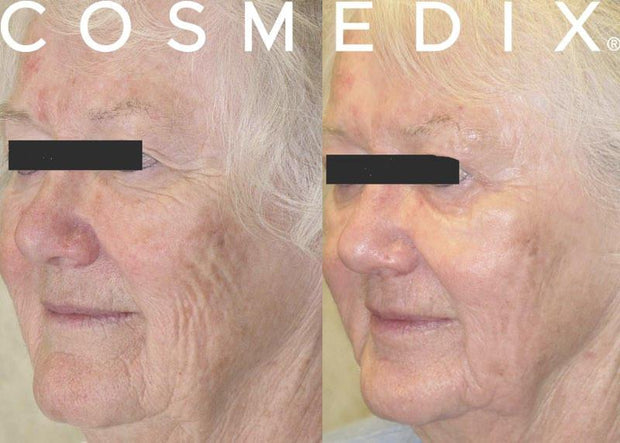 CosMedix Benefit Peel Treatment Menu Professional Cosmedix 